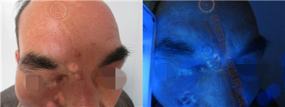 面部白斑三余年,在我院成功治愈