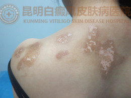 背部白斑一年余,在我院成功治愈