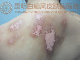 背部白斑一年余,在我院成功治愈