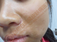 昆明白癜风皮肤病医院——还你花样青春